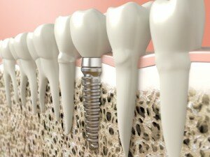Mit Computersimulation können Implantate millimetergenau eingesetzt werden