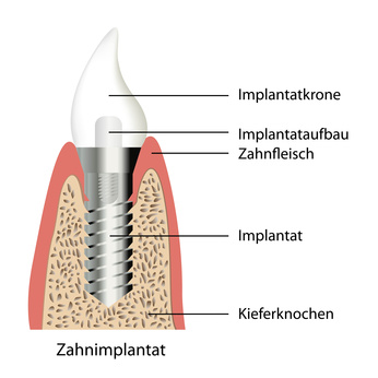 Aufbau Zahnimplantat